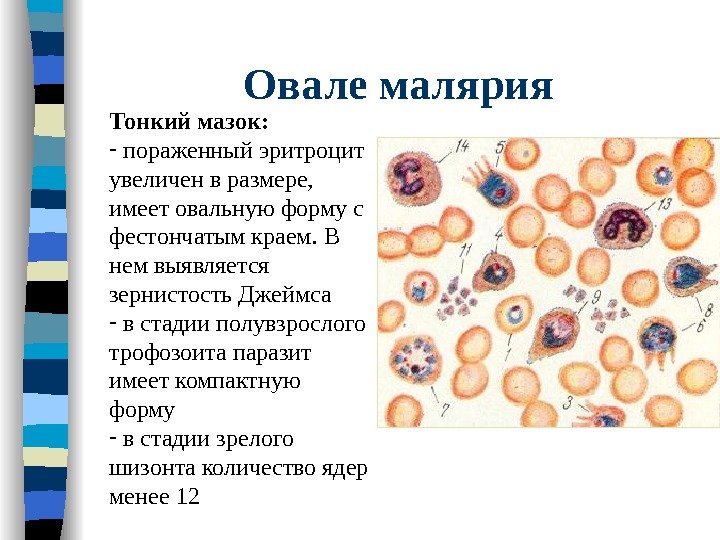 Овале малярия Тонкий мазок: -  пораженный эритроцит увеличен в размере,  имеет овальную